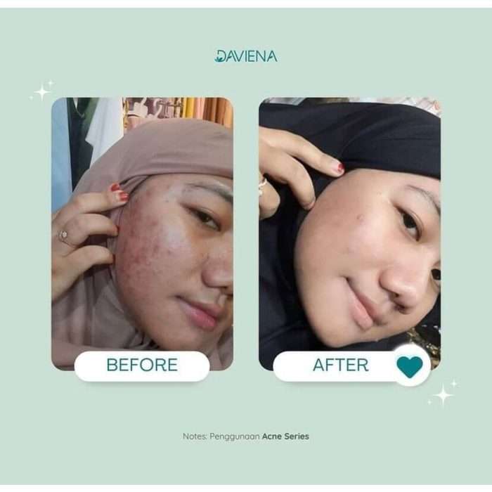 Night Cream Acne Daviena Skincare 2